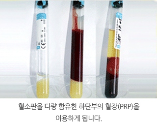 혈소판을 다량 함유한 하단부의 혈장(PRP)을 이용하게 됩니다.